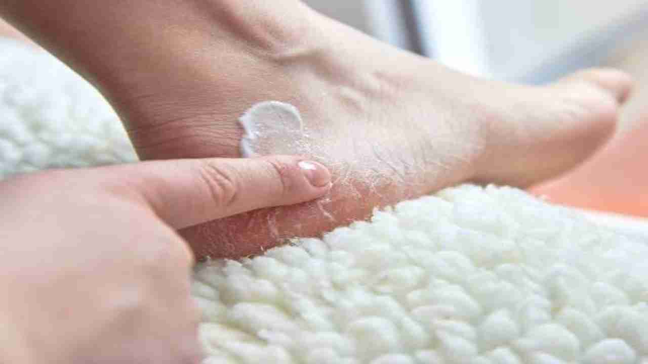 Winter care: Effective home remedies to be rid of cracked heels