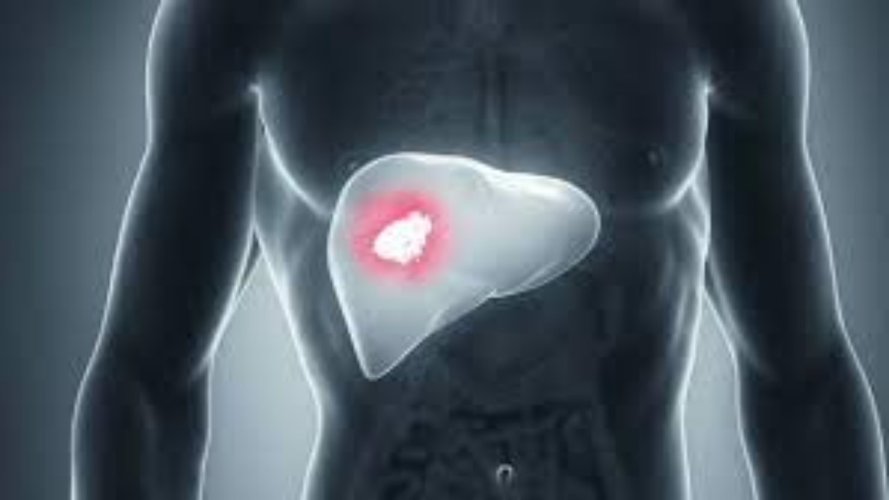 liver cancer