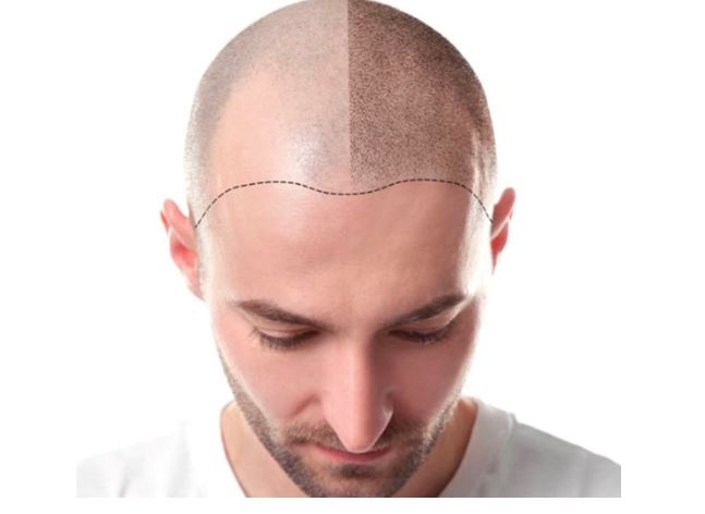 hair transplant