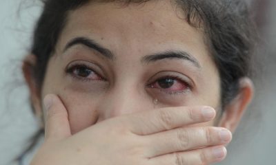 Conjunctivitis cases in delhi